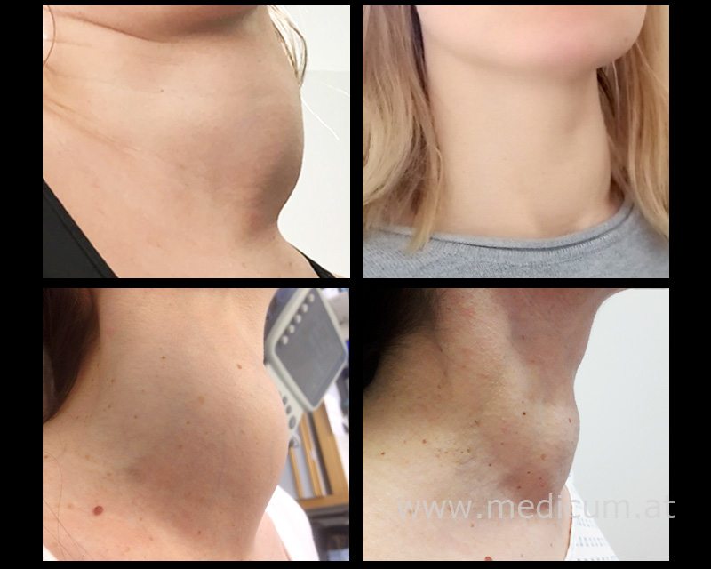 Radiofrequenztherapie